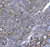IHC staining of FFPE human bladder urothelial carcinoma tissue with MLEC antibody. HIER: boil tissue sections in pH8 EDTA for 20 min and allow to cool before testing.
