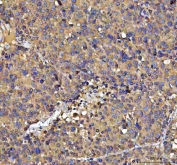IHC staining of FFPE human liver cancer tissue with NUBPL antibody. HIER: boil tissue sections in pH8 EDTA for 20 min and allow to cool before testing.