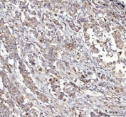 IHC staining of FFPE human lung cancer tissue with NUBPL antibody. HIER: boil tissue sections in pH8 EDTA for 20 min and allow to cool before testing.