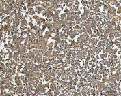 IHC staining of FFPE human lung cancer tissue with NT5C antibody. HIER: boil tissue sections in pH8 EDTA for 20 min and allow to cool before testing.