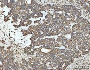 IHC staining of FFPE human ovarian cancer tissue with NT5C antibody. HIER: boil tissue sections in pH8 EDTA for 20 min and allow to cool before testing.