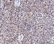 IHC staining of FFPE human large B-cell lymphoma tissue with NUP37 antibody. HIER: boil tissue sections in pH8 EDTA for 20 min and allow to cool before testing.