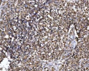 IHC staining of FFPE human ovarian cancer tissue with NUP37 antibody. HIER: boil tissue sections in pH8 EDTA for 20 min and allow to cool before testing.