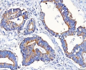 IHC staining of FFPE human colorectal adenocarcinoma tissue with METAP1D antibody. HIER: boil tissue sections in pH8 EDTA for 20 min and allow to cool before testing.