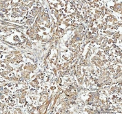 IHC staining of FFPE human lung cancer tissue with NEEP21 antibody. HIER: boil tissue sections in pH8 EDTA for 20 min and allow to cool before testing.