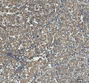 IHC staining of FFPE human bladder urothelial carcinoma tissue with NEEP21 antibody. HIER: boil tissue sections in pH8 EDTA for 20 min and allow to cool before testing.