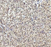 IHC staining of FFPE human cervical squamous carcinoma tissue with Myoneurin antibody. HIER: boil tissue sections in pH8 EDTA for 20 min and allow to cool before testing.