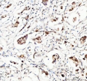 IHC staining of FFPE human breast cancer tissue with Myoneurin antibody. HIER: boil tissue sections in pH8 EDTA for 20 min and allow to cool before testing.