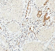IHC staining of FFPE human colorectal adenocarcinoma tissue with Myoneurin antibody. HIER: boil tissue sections in pH8 EDTA for 20 min and allow to cool before testing.