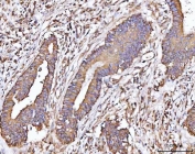 IHC staining of FFPE human colorectal adenocarcinoma tissue with MICAL-like protein 2 antibody. HIER: boil tissue sections in pH8 EDTA for 20 min and allow to cool before testing.