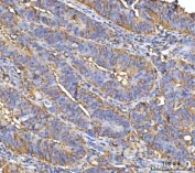 IHC staining of FFPE human colorectal adenocarcinoma tissue with NUDCD3 antibody. HIER: boil tissue sections in pH8 EDTA for 20 min and allow to cool before testing.