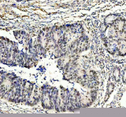 IHC staining of FFPE human colon cancer tissue with PUS7 antibody, HRP-secondary and DAB substrate. HIER: boil tissue sections in pH8 EDTA for 20 min and allow to cool before testing.