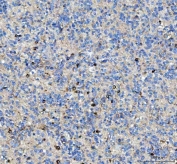 IHC staining of FFPE human glioma tissue with MAP6D1 antibody. HIER: boil tissue sections in pH8 EDTA for 20 min and allow to cool before testing.