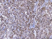 IHC staining of FFPE human adrenocortical adenoma tissue with MAGED4 antibody. HIER: boil tissue sections in pH8 EDTA for 20 min and allow to cool before testing.