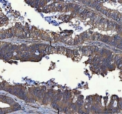 IHC staining of FFPE human colorectal adenocarcinoma tissue with MSLNL antibody. HIER: boil tissue sections in pH8 EDTA for 20 min and allow to cool before testing.