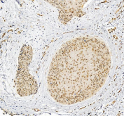 IHC staining of FFPE human skin cancer tissue with FAM55C antibody, HRP-secondary and DAB substrate. HIER: boil tissue sections in pH8 EDTA for 20 min and allow to cool before testing.