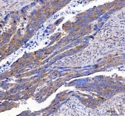 IHC staining of FFPE human colorectal adenocarcinoma tissue with LEKR1 antibody. HIER: boil tissue sections in pH8 EDTA for 20 min and allow to cool before testing.