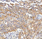 IHC staining of FFPE human urothelial carcinoma tissue with PP18 antibody. HIER: boil tissue sections in pH8 EDTA for 20 min and allow to cool before testing.
