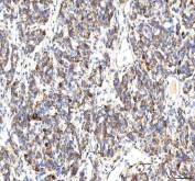 IHC staining of FFPE human lung cancer tissue with PP18 antibody. HIER: boil tissue sections in pH8 EDTA for 20 min and allow to cool before testing.