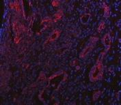 Immunofluorescent staining of FFPE human intestinal cancer tissue with PP18 antibody (red) and DAPI nuclear stain (blue). HIER: steam section in pH8 EDTA buffer for 20 min.