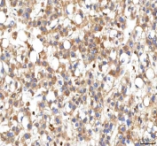 IHC staining of FFPE human liver cancer tissue with PP18 antibody. HIER: boil tissue sections in pH8 EDTA for 20 min and allow to cool before testing.