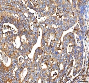 IHC staining of FFPE human colon adenocarcinoma tissue with PP18 antibody. HIER: boil tissue sections in pH8 EDTA for 20 min and allow to cool before testing.