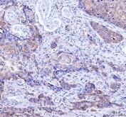 IHC staining of FFPE human esophageal squamous carcinoma tissue with Lysophospholipase 1 antibody. HIER: boil tissue sections in pH8 EDTA for 20 min and allow to cool before testing.