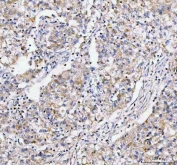 IHC staining of FFPE human lung cancer tissue with Lysophospholipase 1 antibody. HIER: boil tissue sections in pH8 EDTA for 20 min and allow to cool before testing.