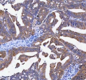 IHC staining of FFPE human rectum adenocarcinoma tissue with Lysophospholipase 1 antibody. HIER: boil tissue sections in pH8 EDTA for 20 min and allow to cool before testing.