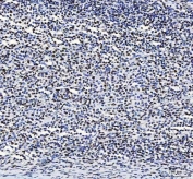 IHC staining of FFPE human large B-cell lymphoma of the colon with LUC7L3 antibody. HIER: boil tissue sections in pH8 EDTA for 20 min and allow to cool before testing.