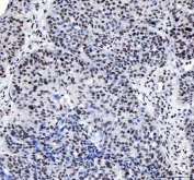 IHC staining of FFPE human ovarian serous adenocarcinoma tissue with LUC7L3 antibody. HIER: boil tissue sections in pH8 EDTA for 20 min and allow to cool before testing.