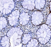 IHC staining of FFPE human highly differentiated adenocarcinoma of the colon with LUC7L3 antibody. HIER: boil tissue sections in pH8 EDTA for 20 min and allow to cool before testing.