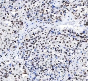 IHC staining of FFPE human liver cancer tissue with LUC7L3 antibody. HIER: boil tissue sections in pH8 EDTA for 20 min and allow to cool before testing.