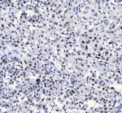 IHC staining of FFPE human lung cancer tissue with LUC7L3 antibody. HIER: boil tissue sections in pH8 EDTA for 20 min and allow to cool before testing.