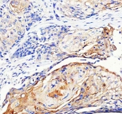 IHC staining of FFPE human esophageal squamous carcinoma tissue with LYPLA2 antibody. HIER: boil tissue sections in pH8 EDTA for 20 min and allow to cool before testing.