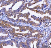 IHC staining of FFPE human rectum adenocarcinoma tissue with LYPLA2 antibody. HIER: boil tissue sections in pH8 EDTA for 20 min and allow to cool before testing.