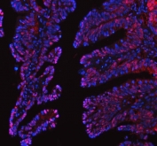 Immunofluorescent staining of FFPE human intestinal cancer tissue with Leukotriene A-4 hydrolase antibody (red) and DAPI nuclear stain (blue). HIER: steam section in pH8 EDTA buffer for 20 min.