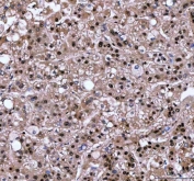 IHC staining of FFPE human liver cancer tissue with Leukotriene A-4 hydrolase antibody. HIER: boil tissue sections in pH8 EDTA for 20 min and allow to cool before testing.