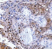 IHC staining of FFPE human esophageal squamous carcinoma tissue with Leukotriene A-4 hydrolase antibody. HIER: boil tissue sections in pH8 EDTA for 20 min and allow to cool before testing.