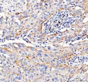 IHC staining of FFPE human bladder urothelial carcinoma tissue with Pyruvate Carboxylase antibody. HIER: boil tissue sections in pH8 EDTA for 20 min and allow to cool before testing.