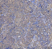 IHC staining of FFPE human ovarian serous adenocarcinoma tissue with Leucine aminopeptidase 3 antibody. HIER: boil tissue sections in pH8 EDTA for 20 min and allow to cool before testing.