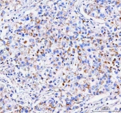 IHC staining of FFPE human lung cancer tissue with IDUA antibody. HIER: boil tissue sections in pH8 EDTA for 20 min and allow to cool before testing.