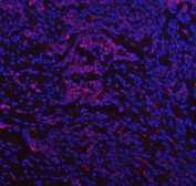 Immunofluorescent staining of FFPE human lung cancer tissue with IDUA antibody (red) and DAPI nuclear stain (blue). HIER: steam section in pH8 EDTA buffer for 20 min.