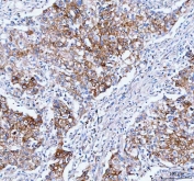 IHC staining of FFPE human lung cancer tissue with IARS1 antibody. HIER: boil tissue sections in pH8 EDTA for 20 min and allow to cool before testing.