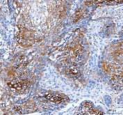 IHC staining of FFPE human esophageal squamous carcinoma tissue with IARS1 antibody. HIER: boil tissue sections in pH8 EDTA for 20 min and allow to cool before testing.