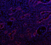 Immunofluorescent staining of FFPE human intestinal cancer tissue with IDH3A antibody (red) and DAPI nuclear stain (blue). HIER: steam section in pH8 EDTA buffer for 20 min.