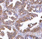 IHC staining of FFPE human rectum adenocarcinoma tissue with IDH3A antibody. HIER: boil tissue sections in pH8 EDTA for 20 min and allow to cool before testing.