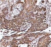 IHC staining of FFPE human esophageal squamous carcinoma tissue with IDH3A antibody. HIER: boil tissue sections in pH8 EDTA for 20 min and allow to cool before testing.