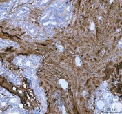 IHC staining of FFPE human thyroid papillary carcinoma tissue with Lumican antibody. HIER: boil tissue sections in pH8 EDTA for 20 min and allow to cool before testing.
