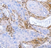 IHC staining of FFPE human esophageal squamous carcinoma tissue with Lumican antibody. HIER: boil tissue sections in pH8 EDTA for 20 min and allow to cool before testing.